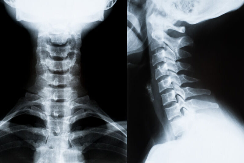 xray collo xray collo